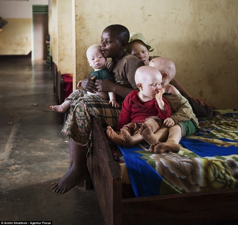 Crianças albinas têm os genitais mutilados na África; imagens fortes!