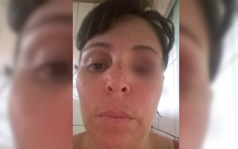 Manicure perdeu olho após ser espancada pelo ex-marido e luta para conseguir cirurgia na rede pública