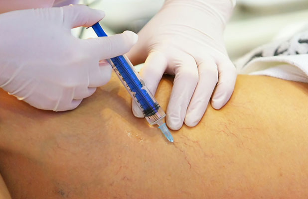 PEIM - Procedimento Estético Injetável para Microvasos PEIM - Procedimento Estético Injetável para Microvasos