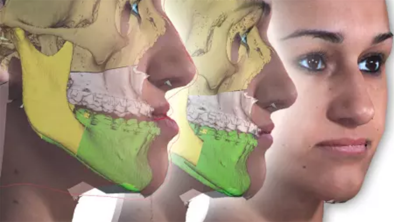 O que é Cirurgia Buco Maxilo Facial?