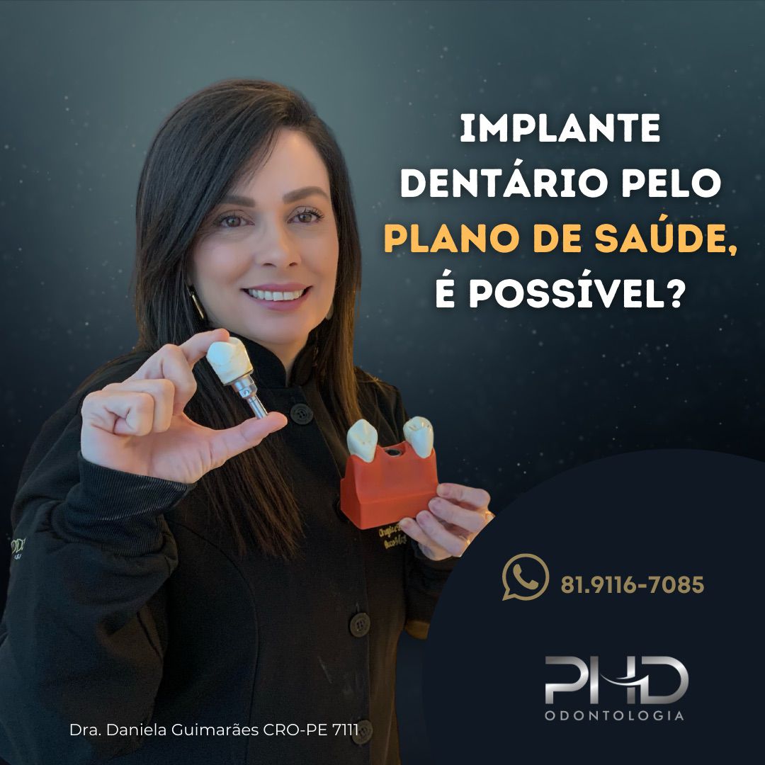 Implantes Dentários
