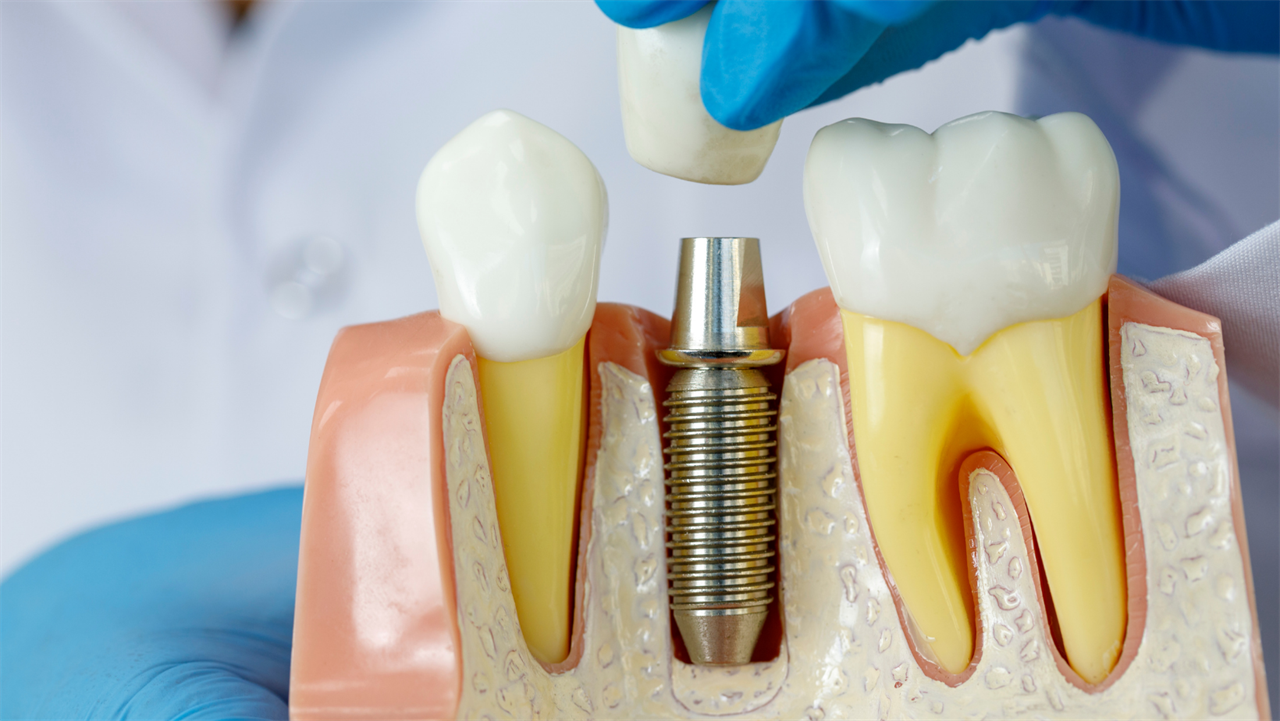 IMPLANTES DENTÁRIOS
