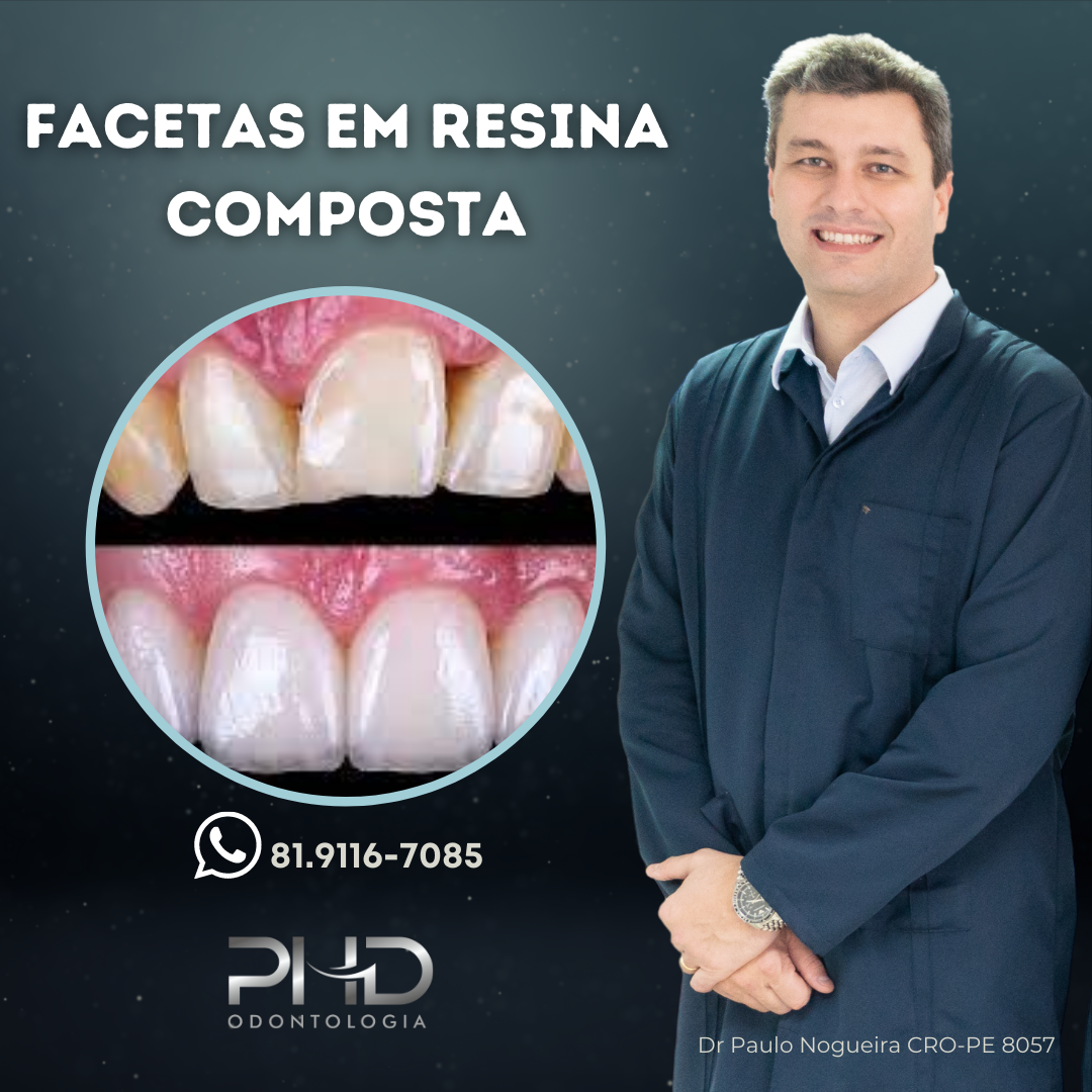 FACETAS EM RESINA COMPOSTA