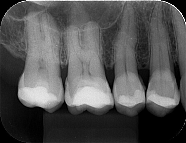 Radiografias Intrabucais